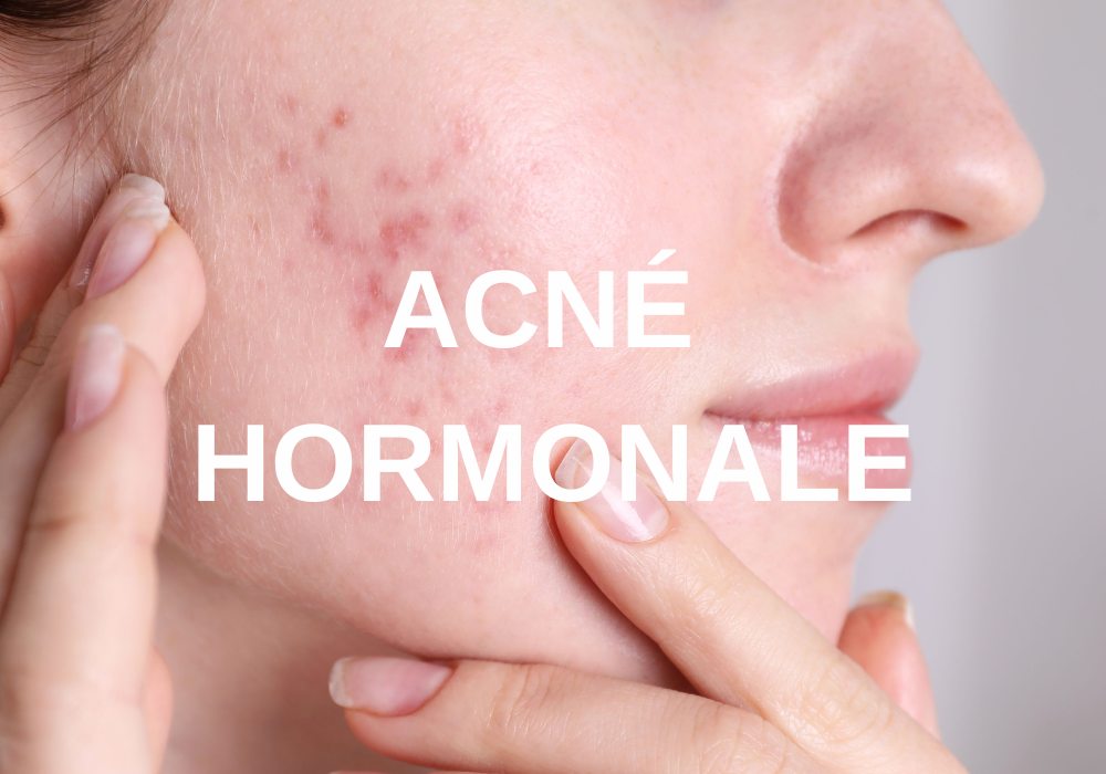 PACK "ACNÉ HORMONALE" 1 MOIS